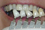 Teeth whitening in Merritt Island, FL